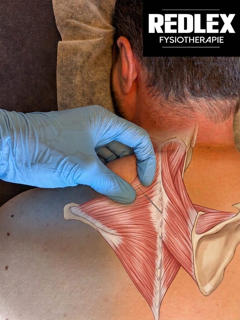 Dry Needling Amsterdam Noord - Redlex Fysiotherapie Amsterdam Noord